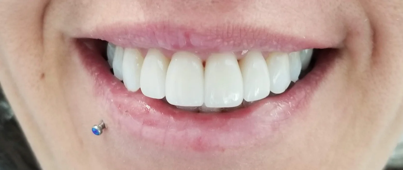 Straight, white ceramic crowns brightened this woman's smile. Conservative drilling ensured she needed no root canals.