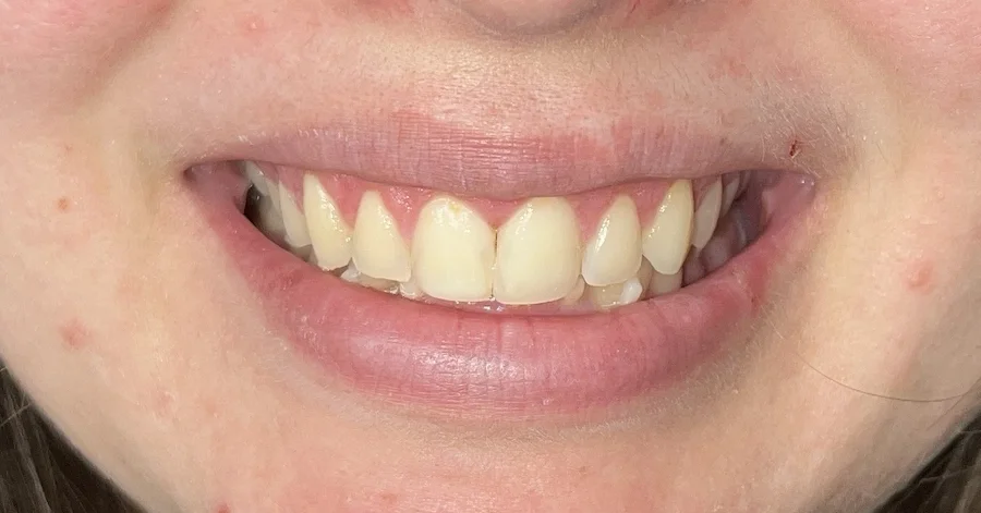 After photo — gum contouring and tooth bonding smile transformation, Phoenix AZ dentist