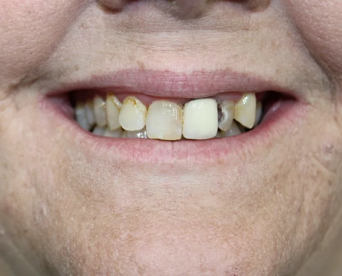 Before photo — patient missing teeth after three years without a denture, Phoenix. Advanced gum disease and decay damaged this woman's self-confidence and her job prospects.