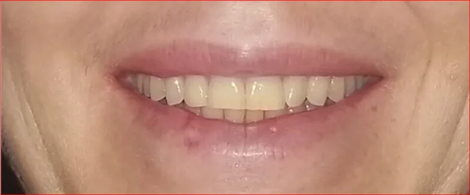Before photo — teeth worn from aging and stained from coffee and wine, Phoenix patient. Mature teeth with natural wear and staining. She wanted to lighten her teeth and make them longer without injections or cutting the teeth.