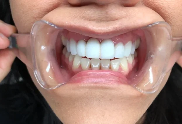Before photo — opaque frosted dental bridge, cosmetic dentistry Phoenix AZ