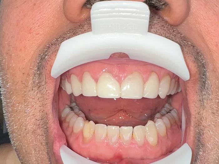Before photo — Veneers placed years ago had cracked and receded, leaving gaps and an outdated appearance. Dr. Ebner carefully removed the old veneers and replaced them with new ceramic veneers, slightly lightened to look fresh and natural, not "denta