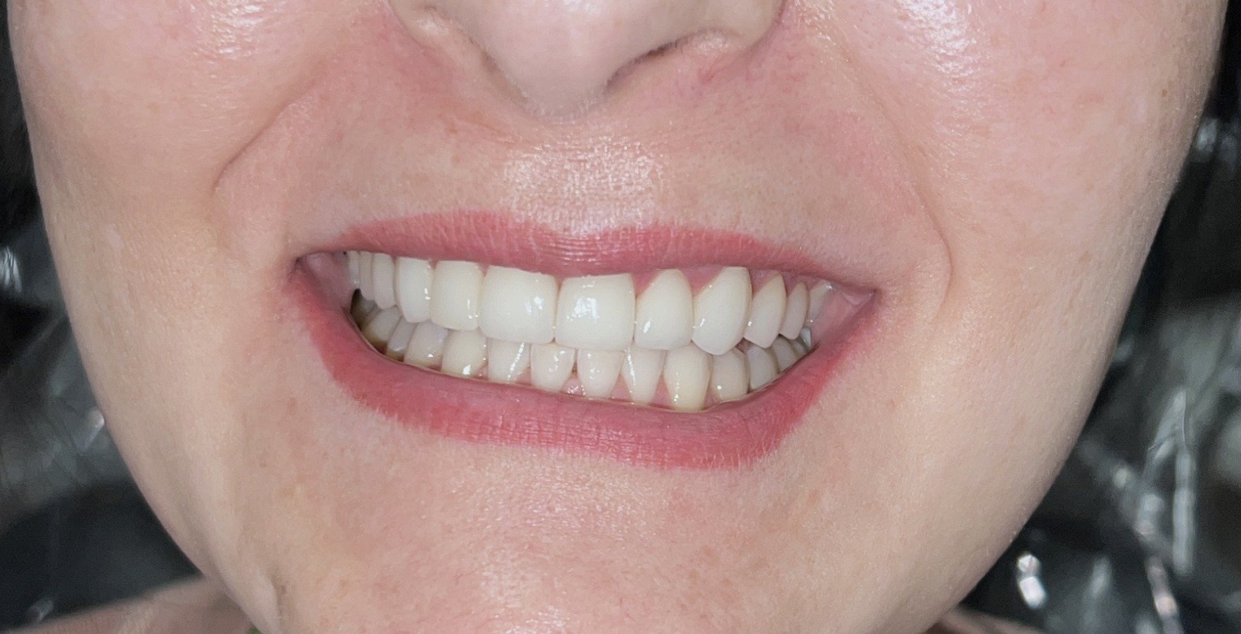 10 ceramic dental veneers Phoenix Dental office