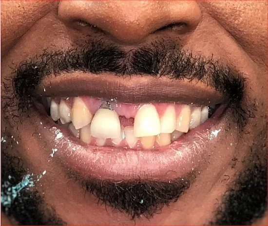 Before Photo-decay and accessed root canal tooth good candidate for smile makeover. Fear of the dentist kept this professional man from getting the care that he needed. It effected his confidence and his career goals.
