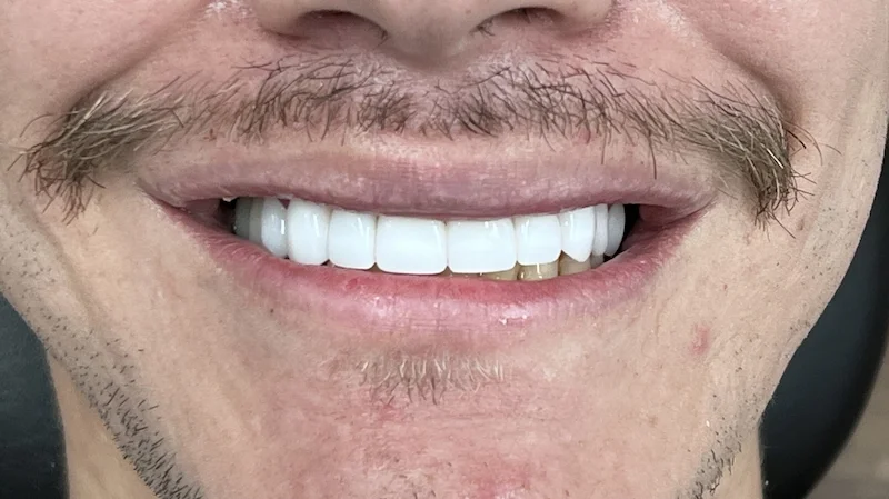 After photo — full smile transformation with whitening, veneers and crowns, Dr. Ebner Phoenix. Bright, white veneers permanently changed his look and improved his satisfaction with his smile. 