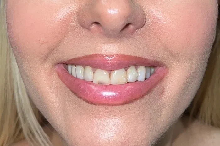Before photo — worn and discolored teeth, candidate for porcelain veneers Phoenix