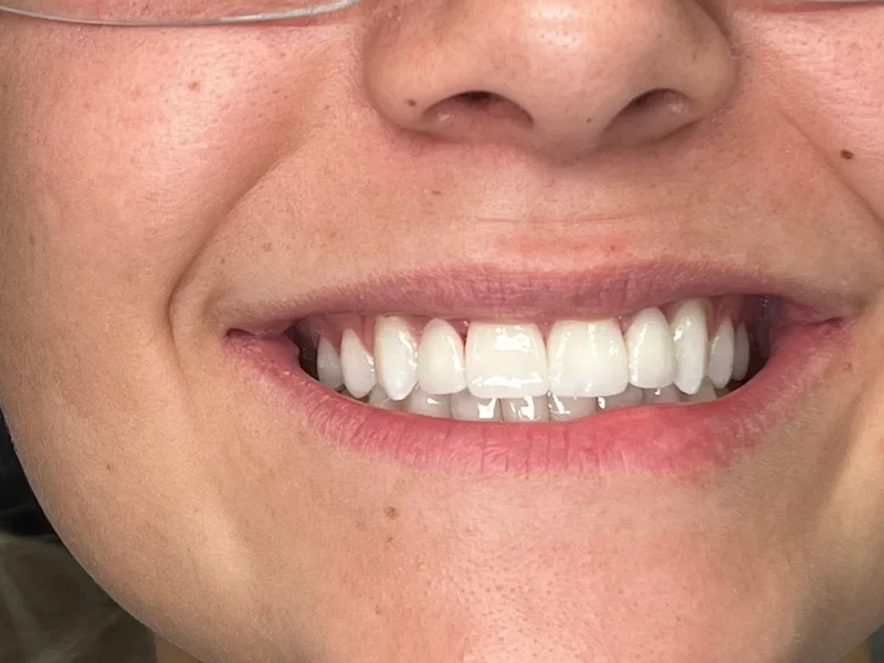 After Photo- ceramic crowns Phoenix, AZ. Ceramic crowns restored broken teeth with perfect color matching to her natural teeth.