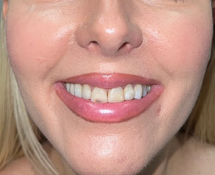 Before photo- stained and chipped dental bonding. Candidate for dental veneers- Phoenix,AZ. This woman's dental composite bonding was only three years old and already stained and broken.