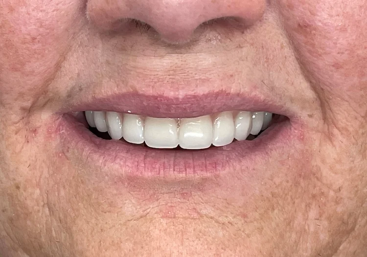  After photo — After three years without a denture, this patient had adapted her life around missing teeth. Dr. Ebner designed a full custom denture built for natural fit and bleach-white aesthetics, giving her back the teeth she thought were gone fo