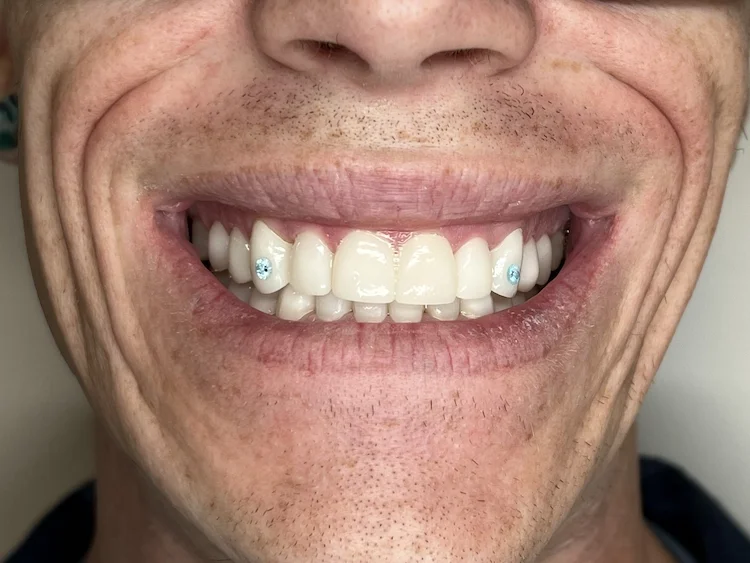 After photo — Worn, broken, and darkened teeth had eroded this patient's confidence. Dr. Ebner designed a three-phase plan: Invisalign to align, professional whitening to brighten, then custom porcelain veneers to perfect the shape and symmetry. The 