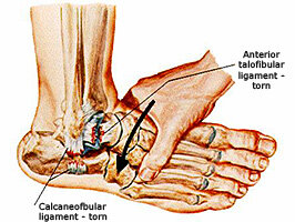 Foot Surgery — Foot & Ankle Surgeons in Willoughby Ohio | North Eastern