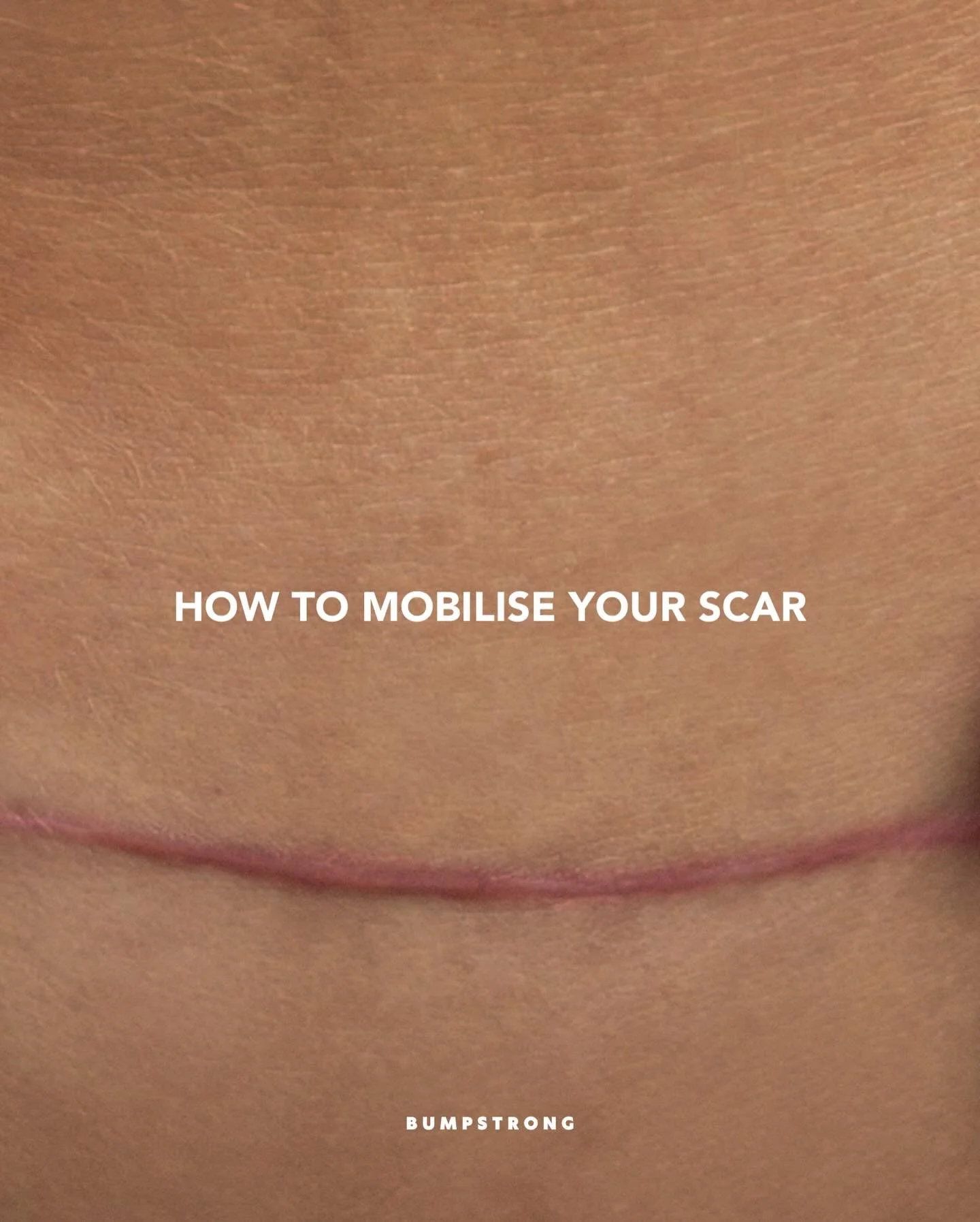 If you&rsquo;ve heard about C-section scar mobilisation&hellip; but have no idea where to start - this is for you ❤️&zwj;🔥

These are simple techniques you can start once cleared to move into mobilisation (saving the Pinch &amp; Lift for last as it&