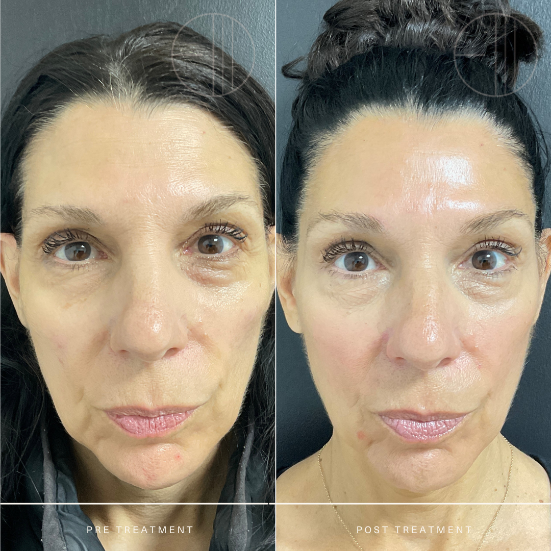 03.07.22.LH.Sculptra&Filler.WEB.png