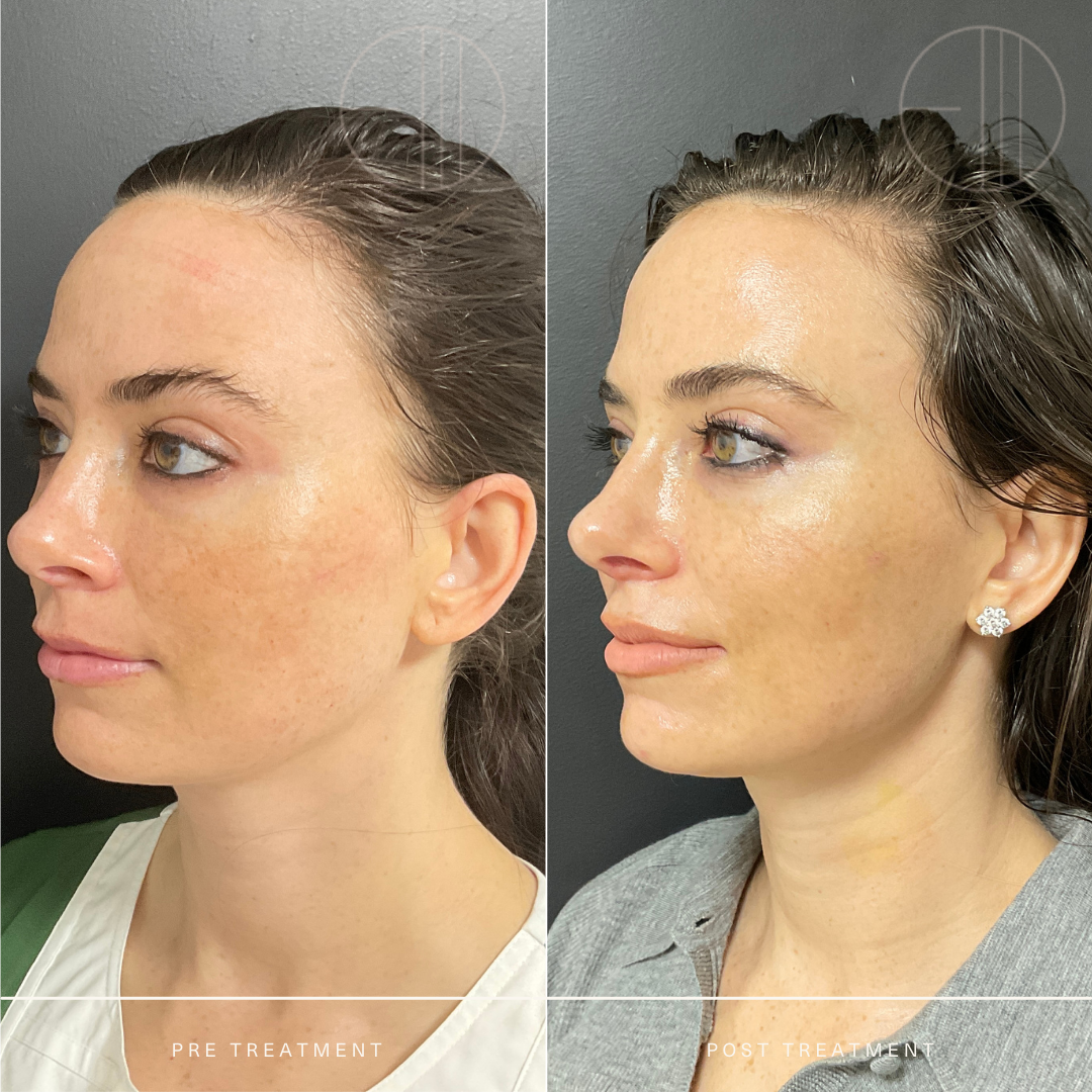 Chemical Peel — Entière Dermatology