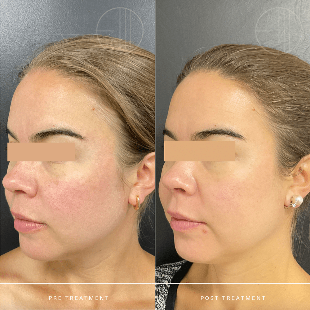 Derma-V — Entière Dermatology