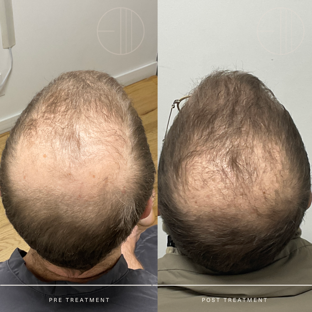 01.30.23.SB.HairLoss..WEB.png