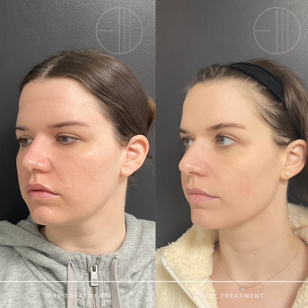 Derma-V — Entière Dermatology