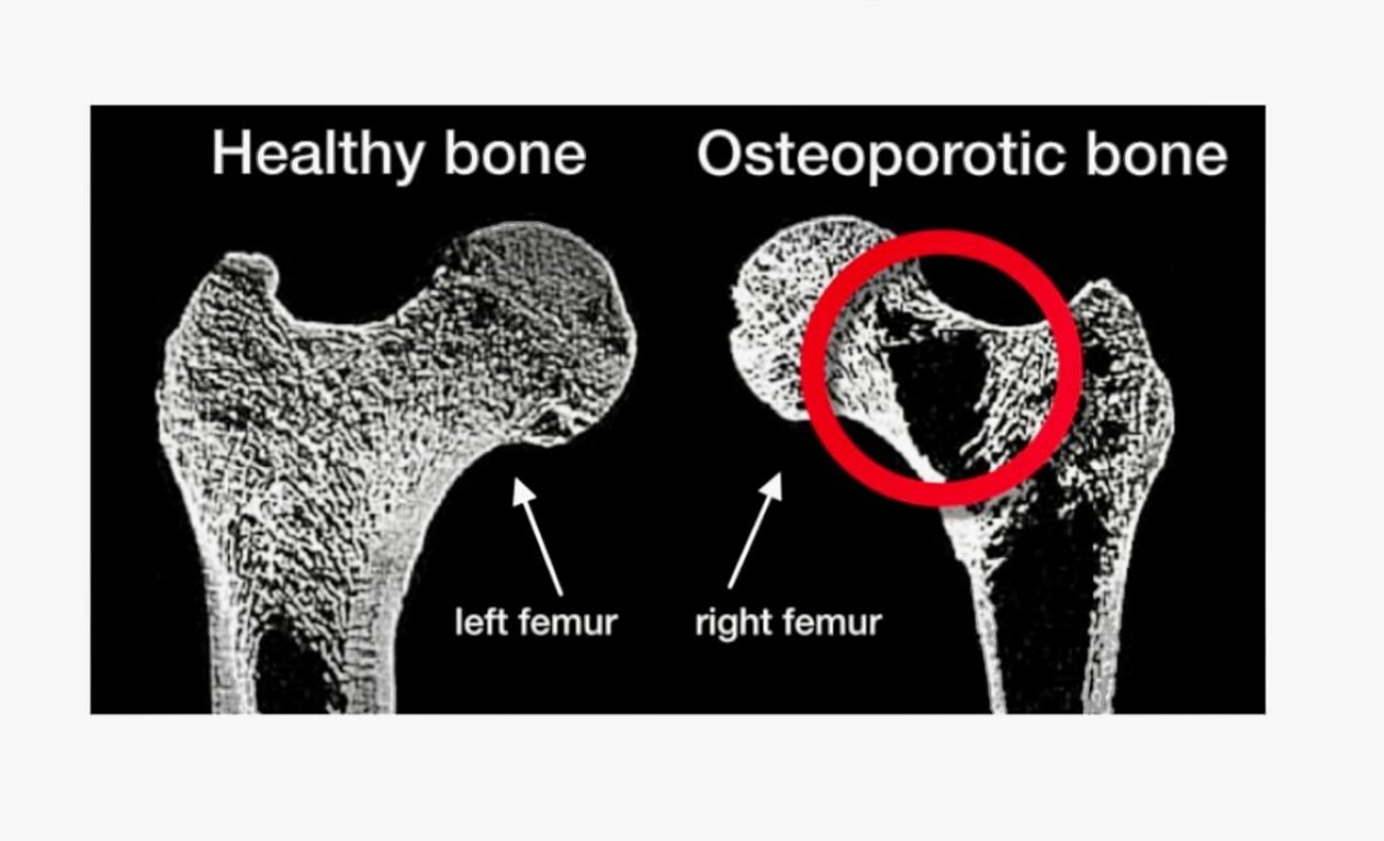 Bone Loss: The Silent Thief of Strength, Confidence and Independence