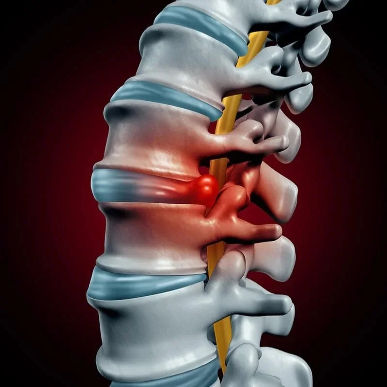 Do Discs Really Slip? The Myth, the Facts, and What’s Actually Happening in Your Spine