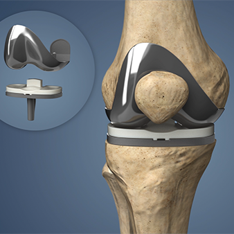 Essential Guide to Knee Replacement Rehabilitation: Prehab, Recovery Phases, and Long-Term Success