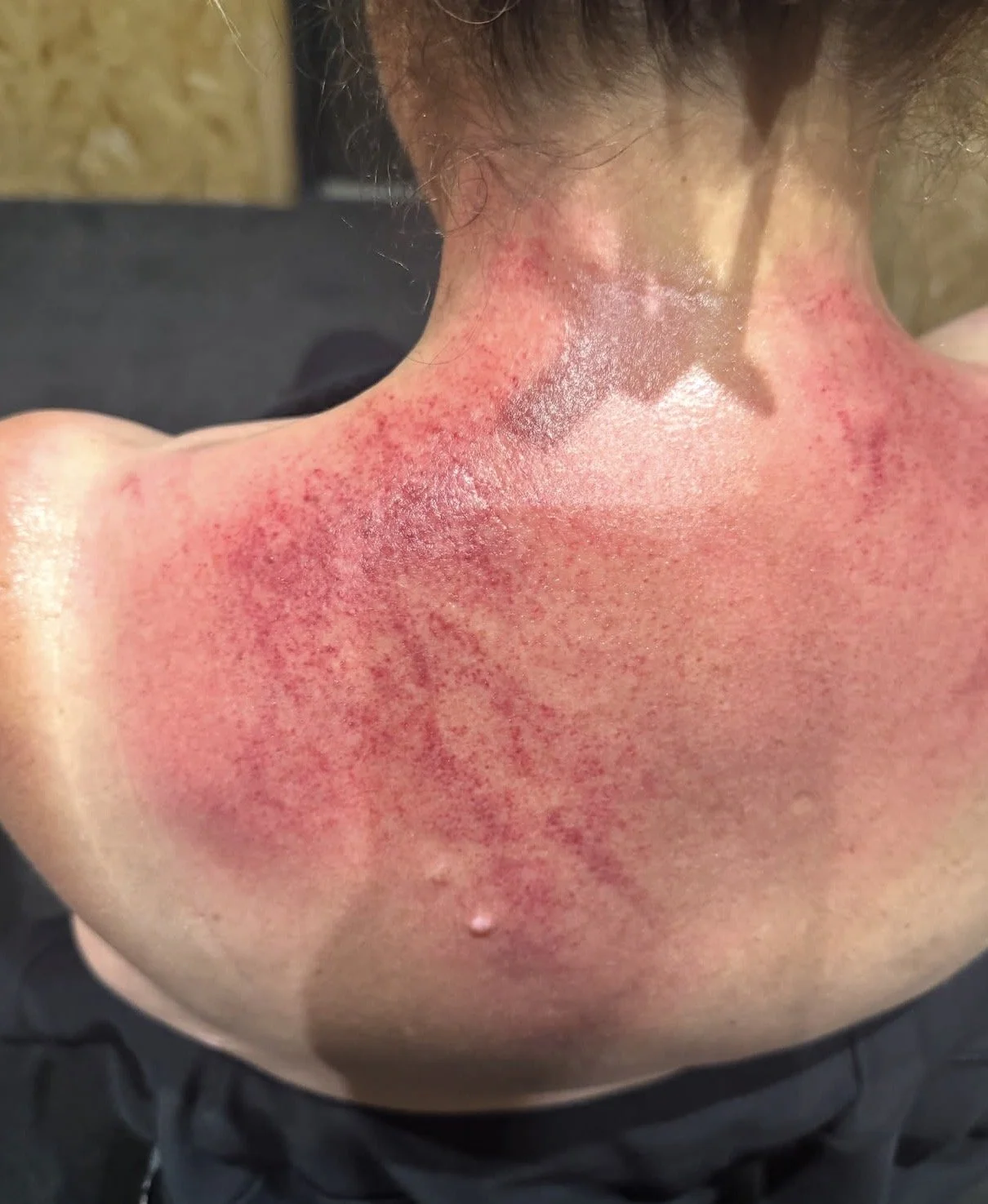 Muscle Scraping: Science, Scam, or Something in Between?