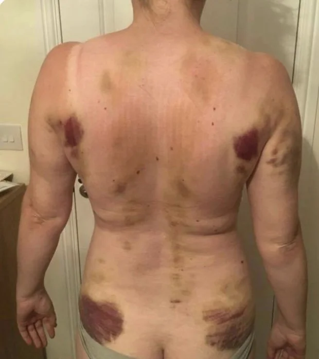 Should You Be Bruised After a Sports Massage?