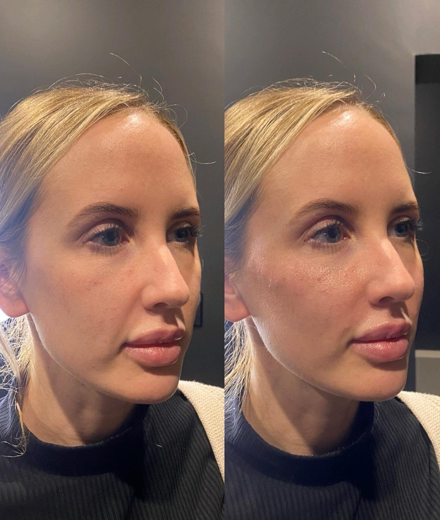 Refresh 🌟

This gorgeous client came to Shan concerned about her nasolabial fold (line that runs from the corner of the nose to the corner of the mouth).

Shan has used dermal filler to address this concern! Firstly by placing dermal into the cheek 