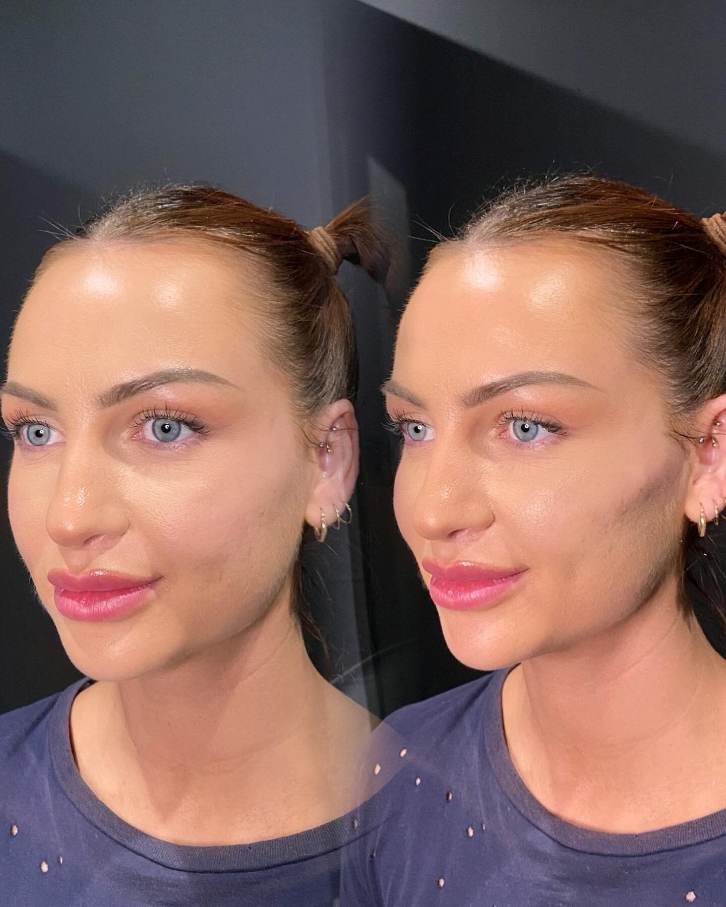 Cheek Filler 🌟 

Cheek Filler is like contour that doesn&rsquo;t wash off! Shan has used Cheek Filler for this patient to create more definition and structure to the mid face! 

Treatment: Cheek Filler
Pricing: from $600 
Longevity of result: 18-24 