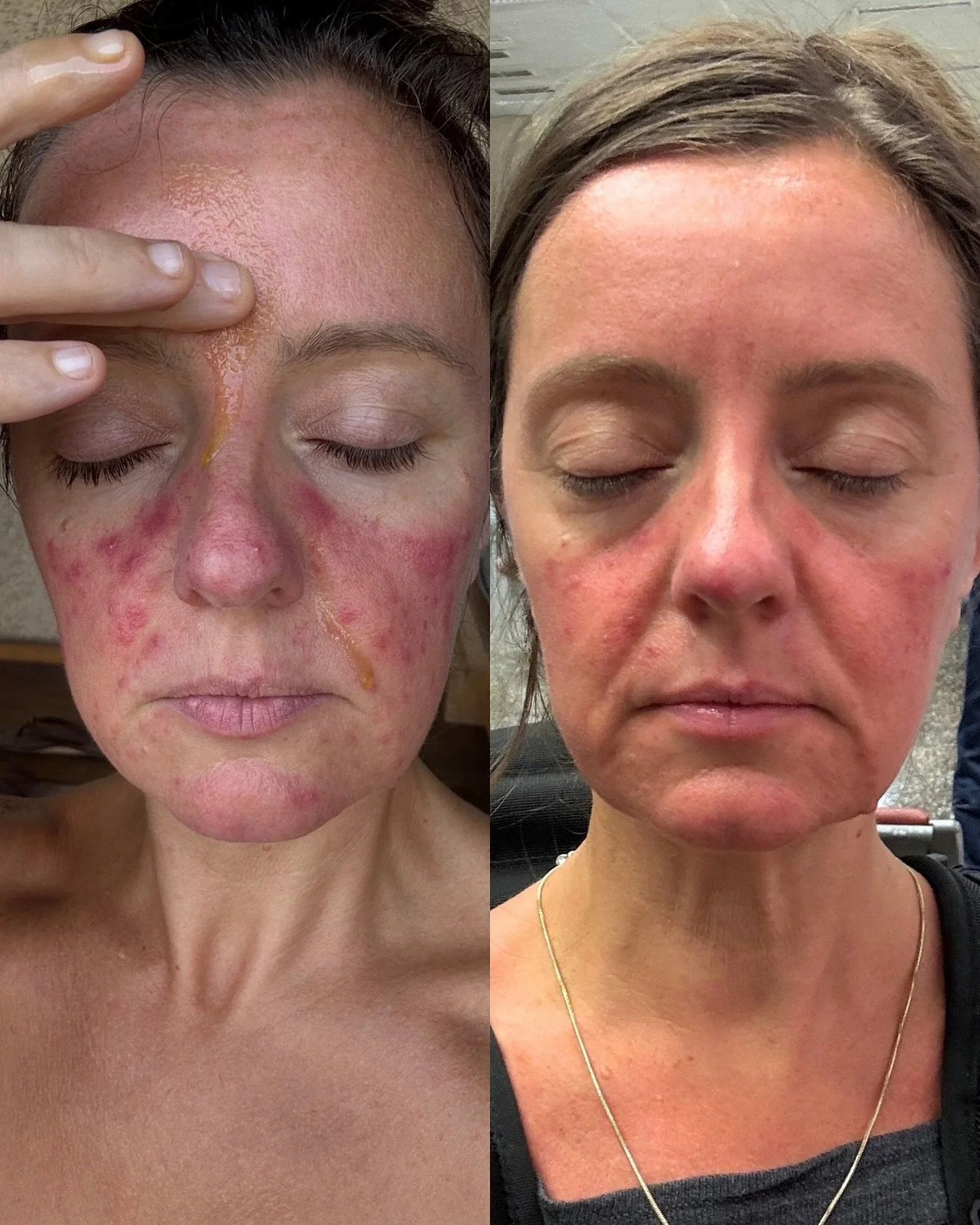 Sometimes a simple, more gentle approach can have major impacts!

These before and after photos were taken 12 hours apart with a facial in between. 

In this particular facial I focused on lymphatic drainage, facial reflexology and craniosacral work 