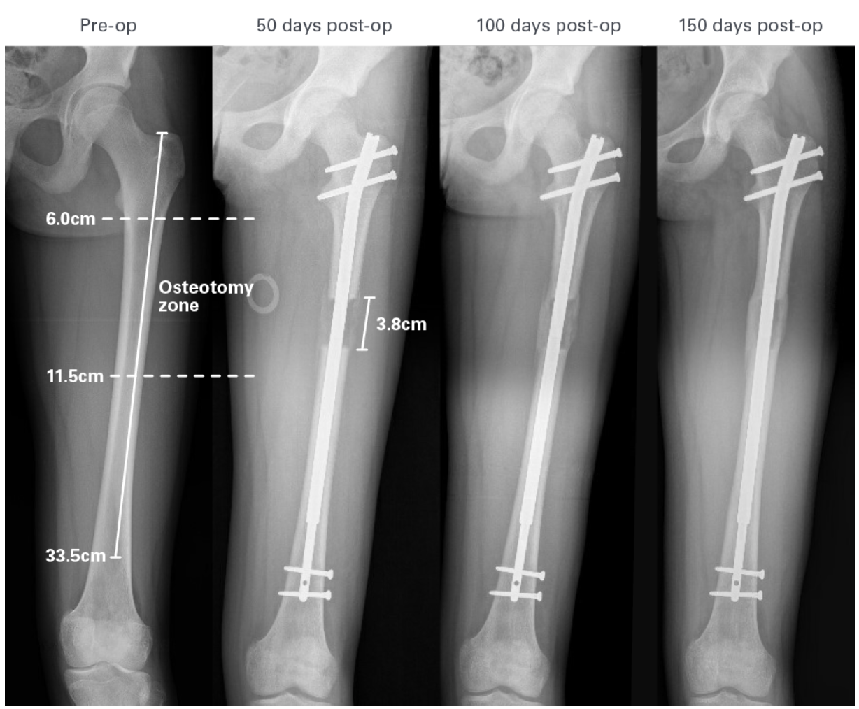 Phases of bone consolidation using Precise Stryde™ Nail.