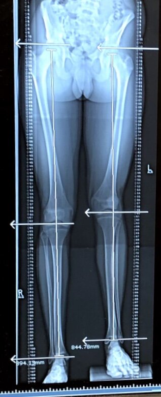 Limb Lengthening, Week 1: The Surgery and Initial Recovery