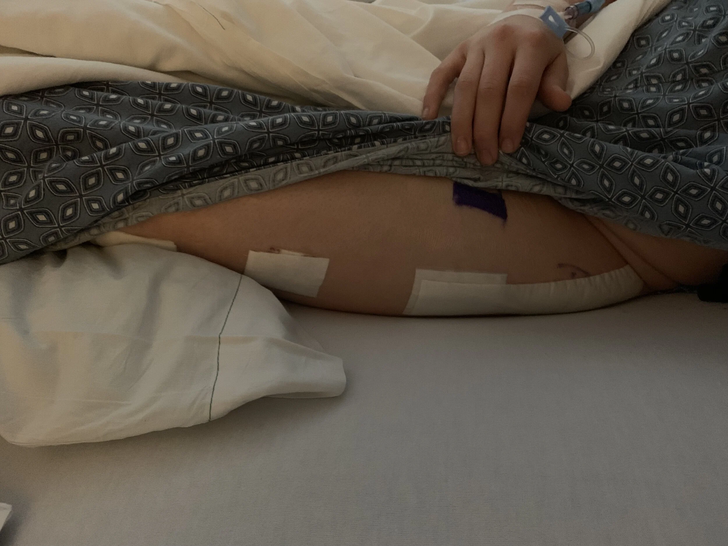 Another view of the wound bandaging. 
