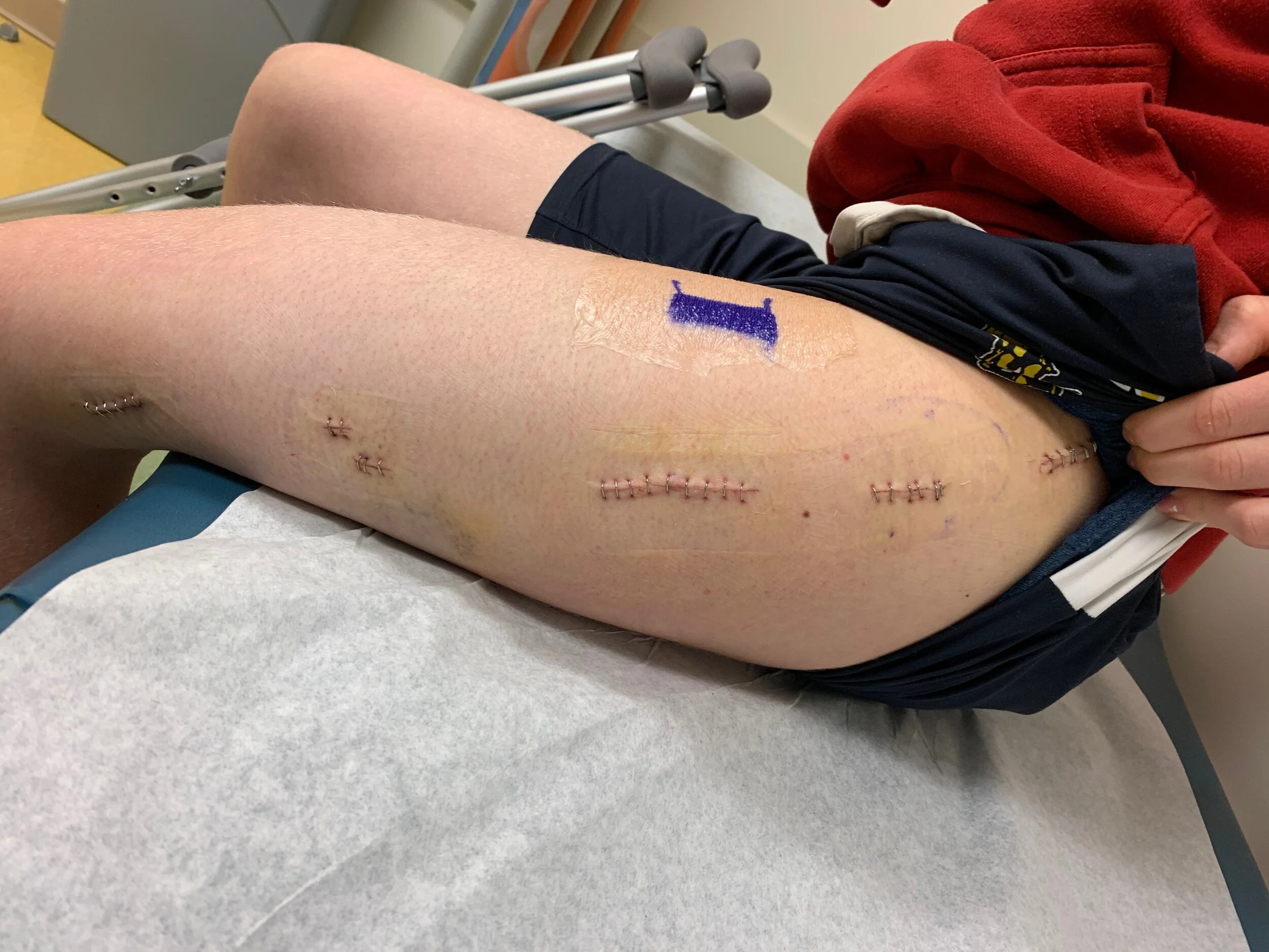 All 6 incisions before the staples were taken out. 