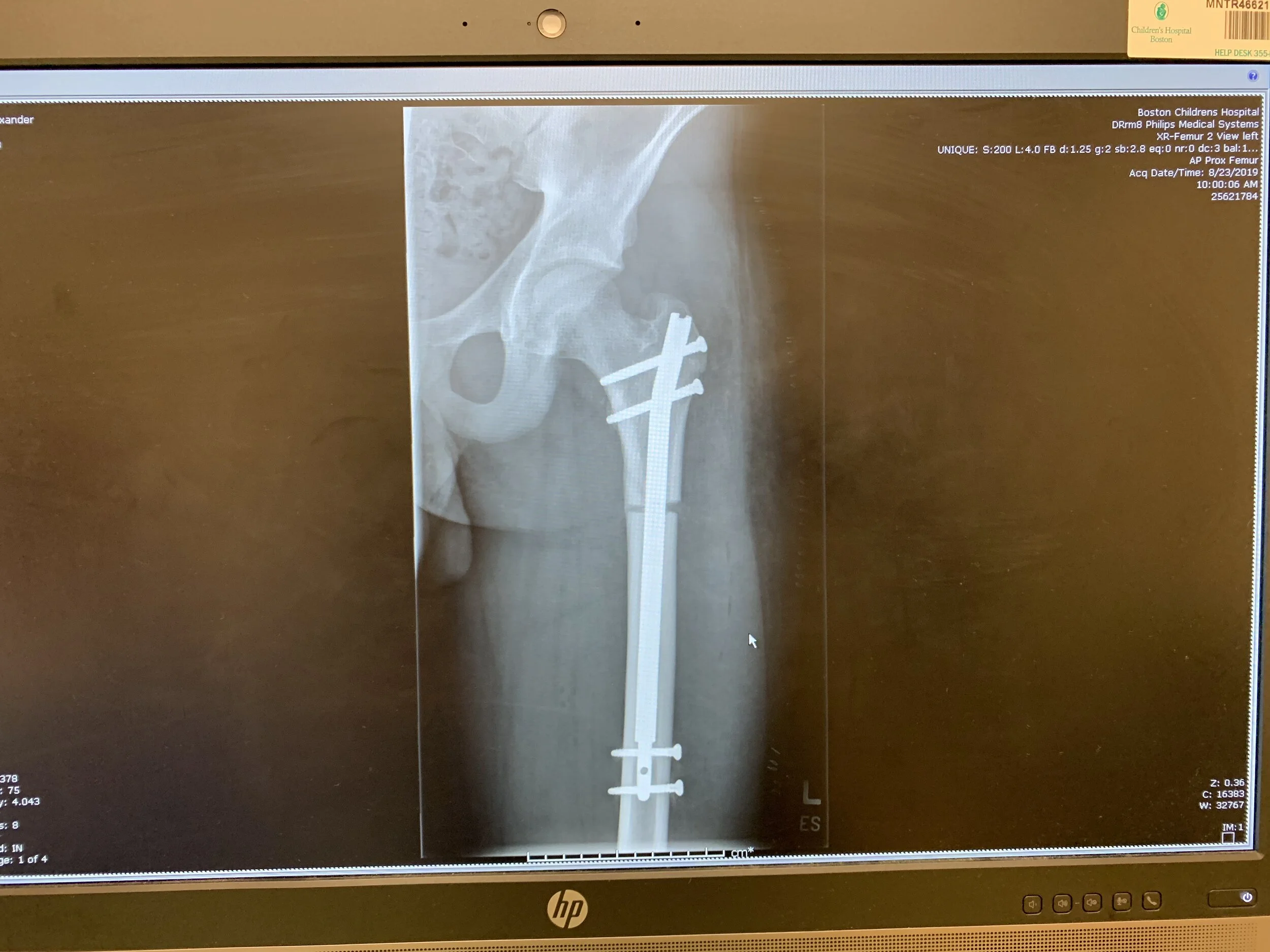 This image was my first x-ray. I had not started to lengthen. 
