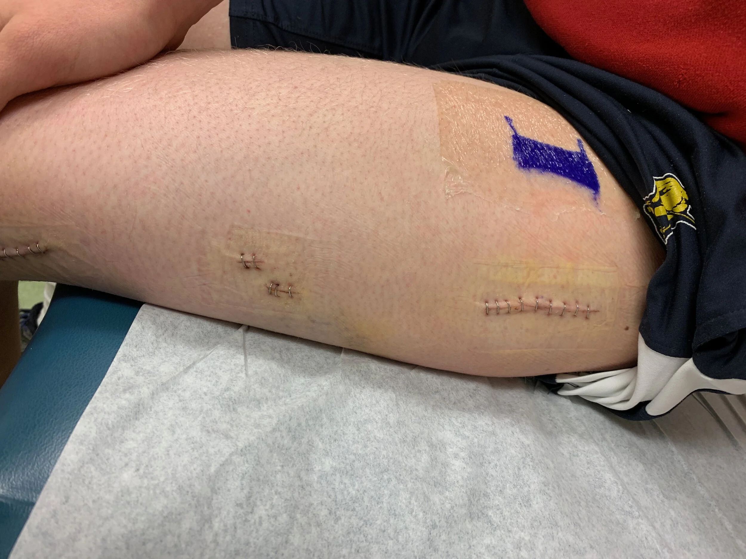 Incisions after bandages were removed. 