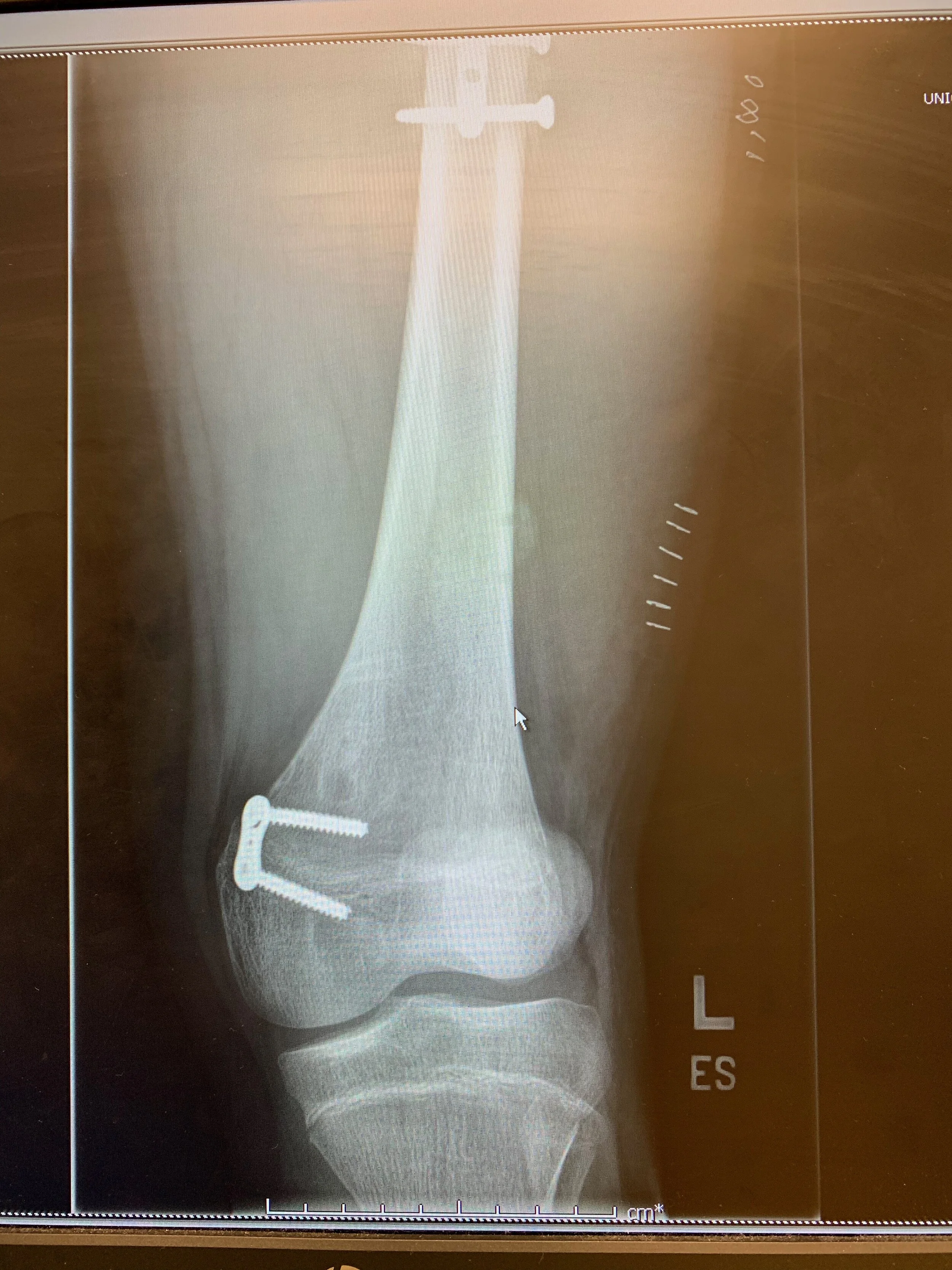 An x-ray of the 8-plate in my knee. 