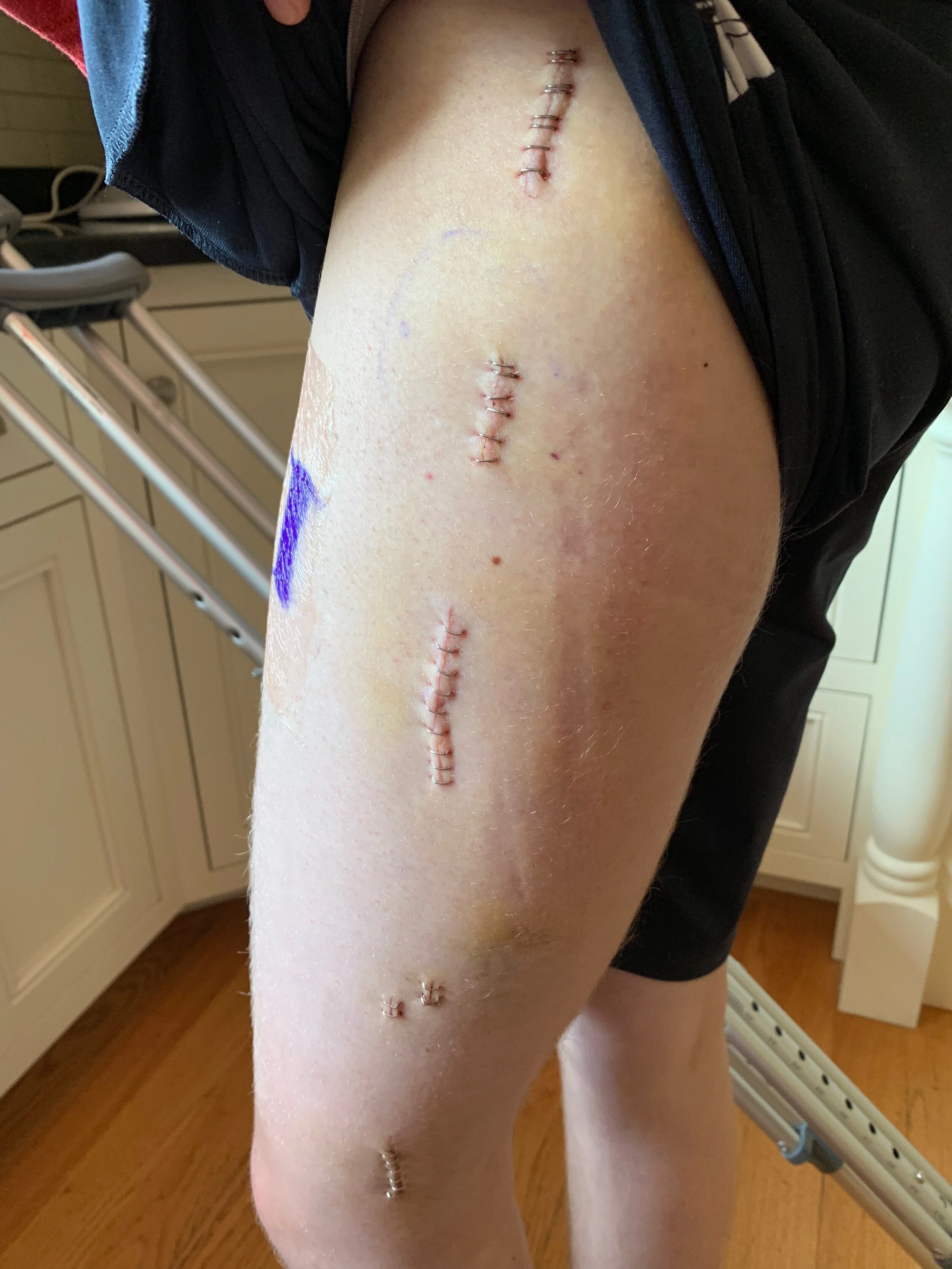 A few days after removing bandages. 