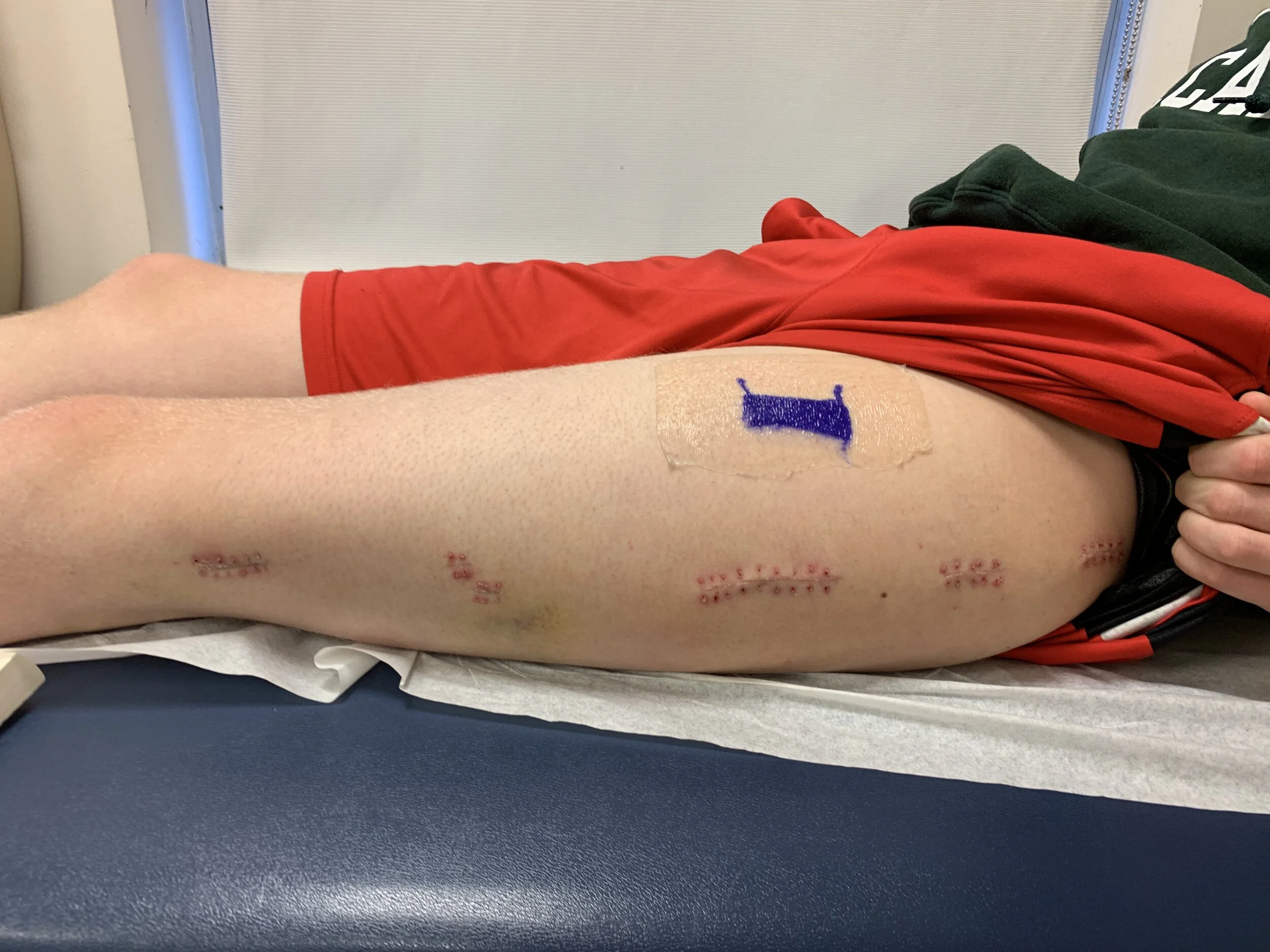 Post-staple removal. 