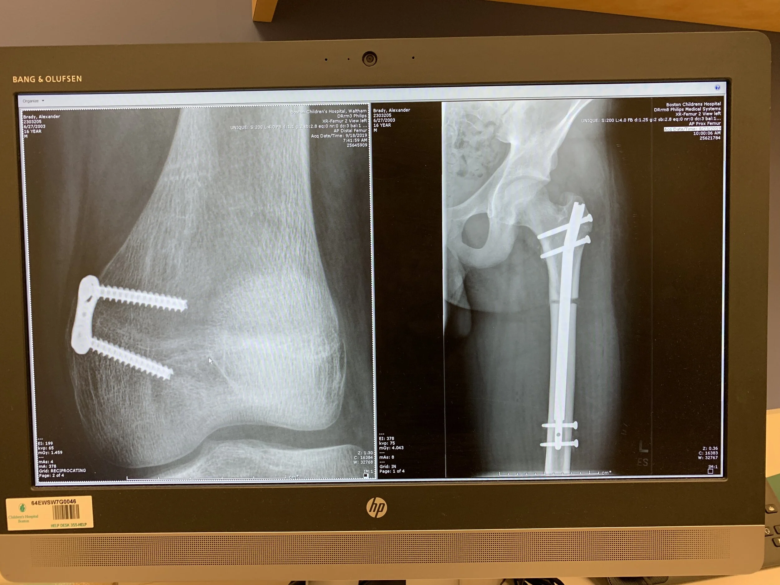 A side-by-side of the 8-plate and Precise Nail. 