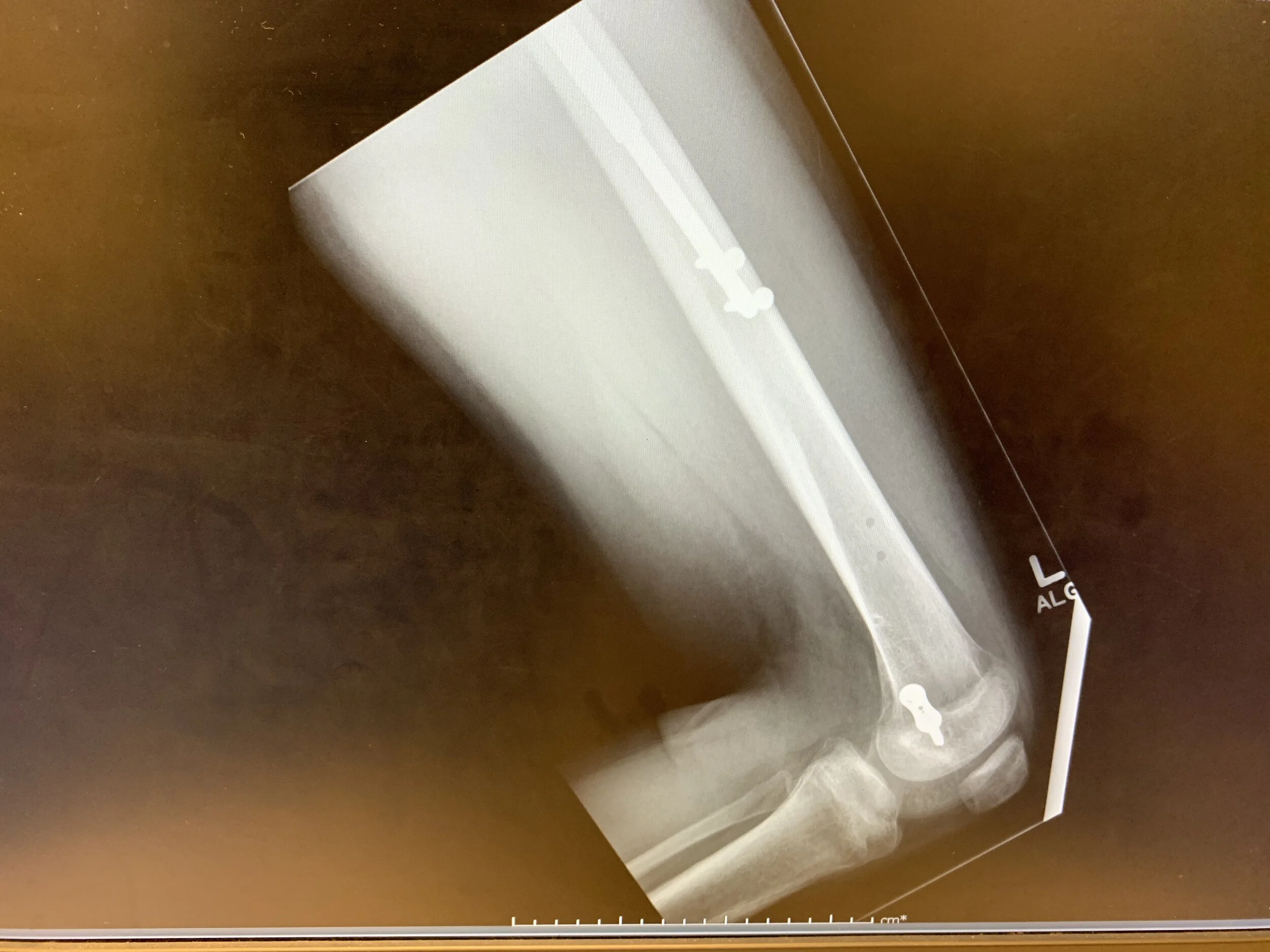 A side view of my lower thigh near the end of the lengthening phase. 