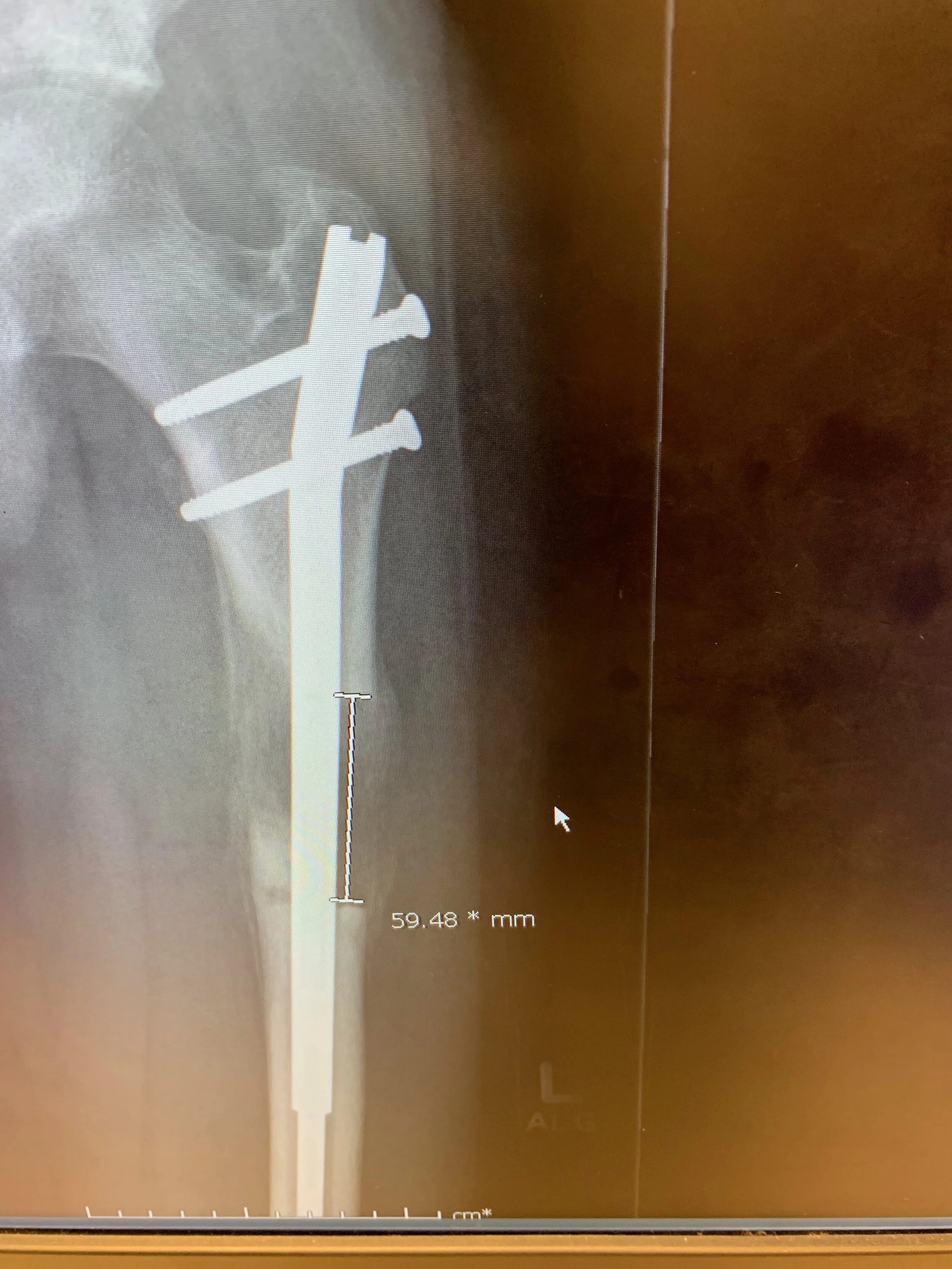 An x-ray showing the estimated achieved distraction in millimeters. 