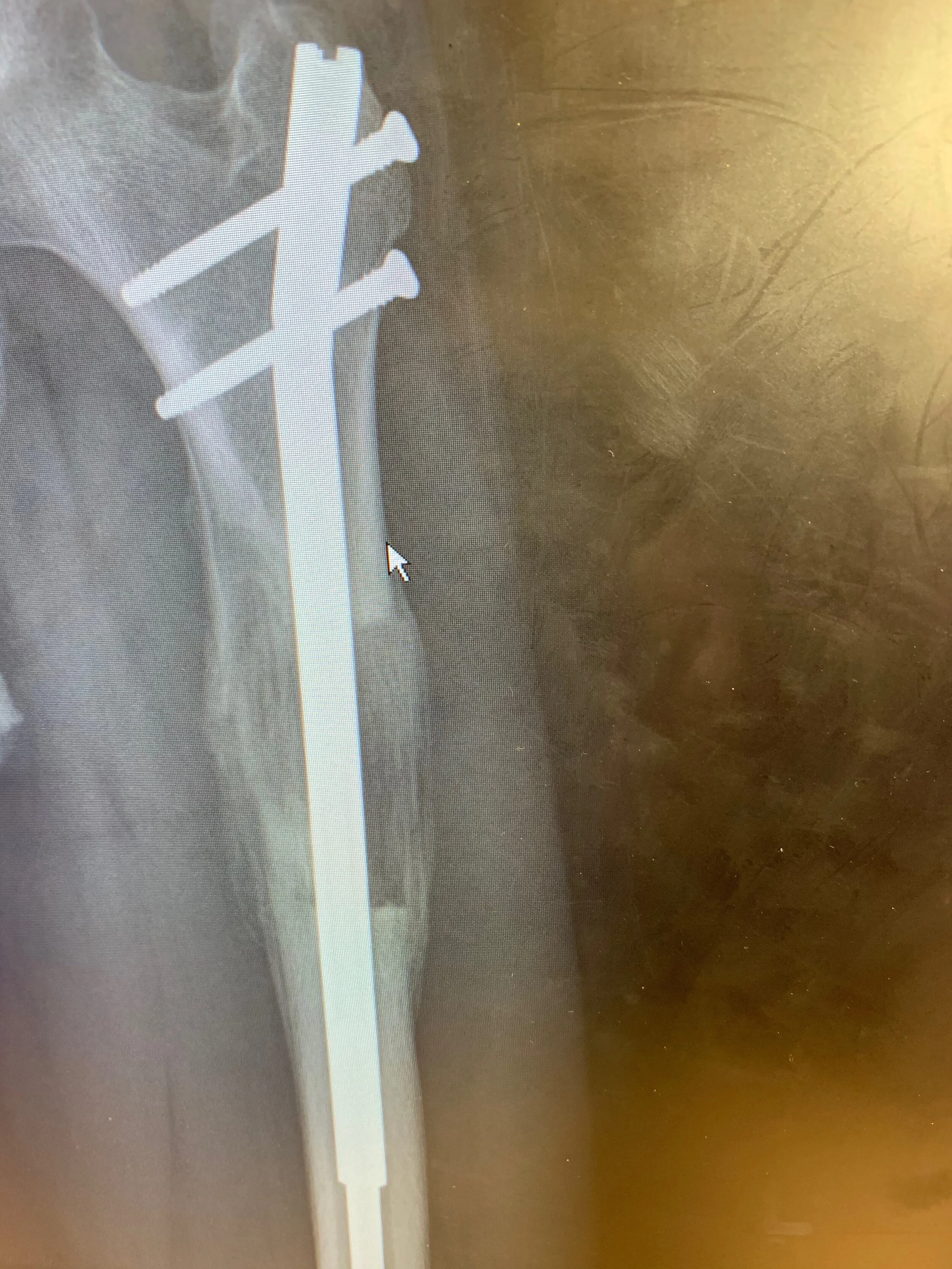 This x-ray was taken about a month after lengthening ended. 
