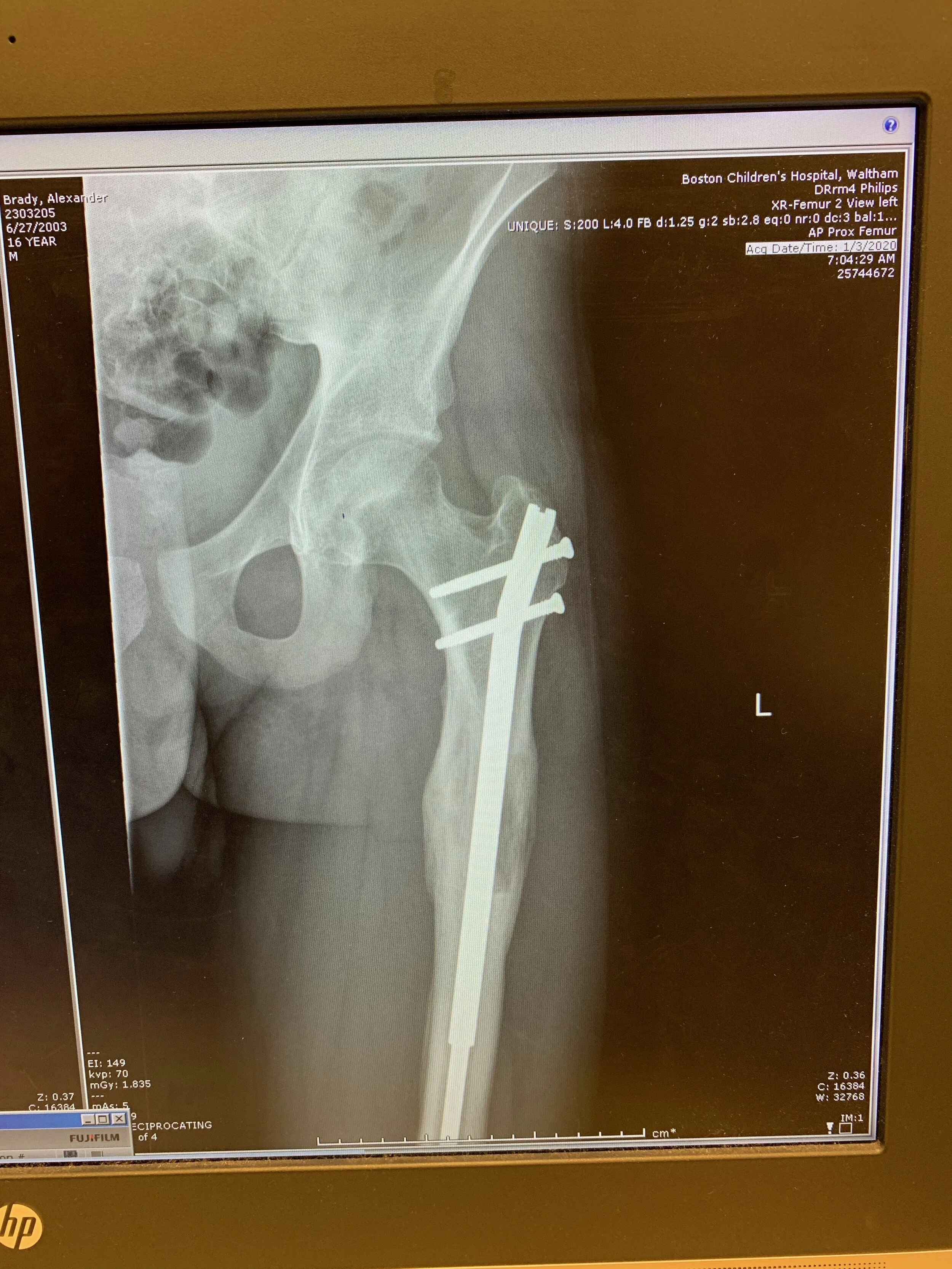 X-ray several months after lengthening ended. 
