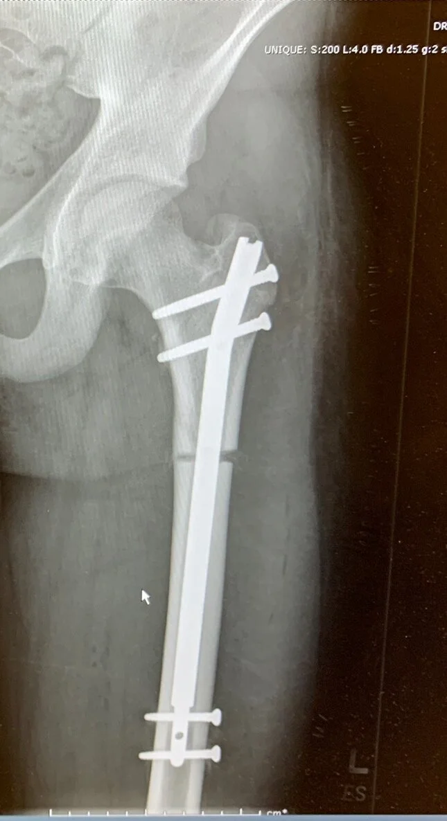 Limb Lengthening, Weeks 2-4: Beginning the Lengthening