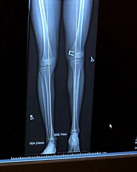 Epiphysiodesis Surgery