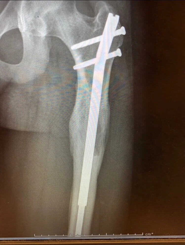 bone growth 2.5 months after stopping the lengthening process