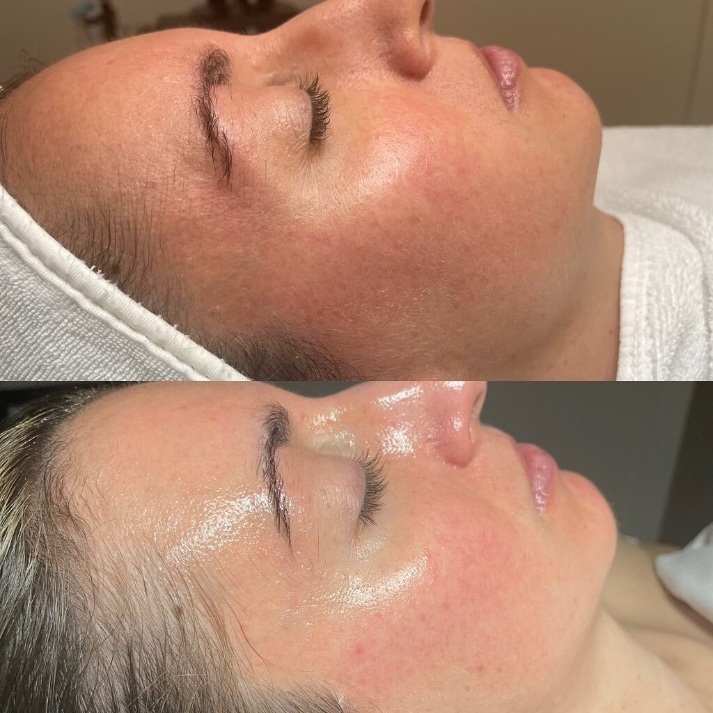 Real clients, real results. This client has a tailored treatment plan: series of 4 microneedling with 2 collagen facials in between. The goal was to induce collagen to refine texture and fine lines. 

Esthetician: @estheticsbyjenee 

#boiseestheticia