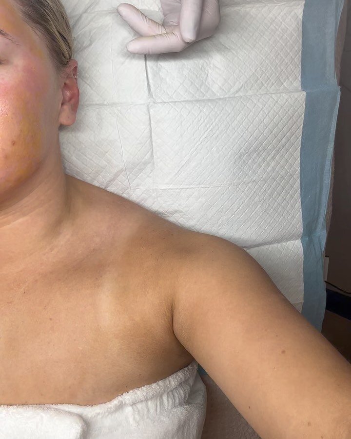 Last peel of the season! Timeless + Deep Sea peel process. Days 1-4. Stay tuned for days 5-8. Prep is required for this level of deep exfoliation. The optimal time to receive one is Fall-Spring.

This is Nadia&rsquo;s favorite treatment, and she is o