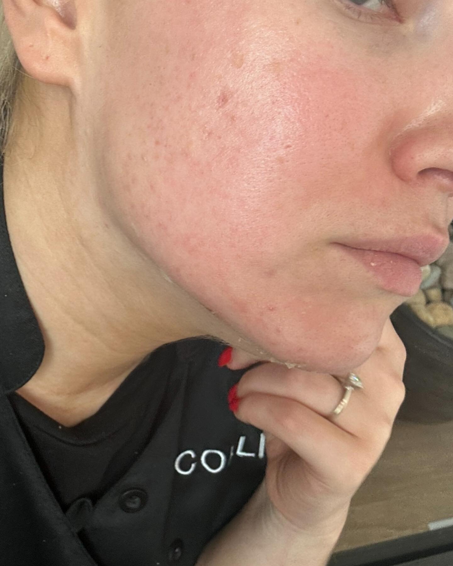 Timeless + Deep Sea Peel days 5-8. Slight flaking on forehead. Couple spots of pigmentation lifting. Smoother and even looking complexion. Some purging is healing. 

#boiseesthetician #boisespa #eagleidaho #hellomeridian #boisebucketlist #skinbrighte