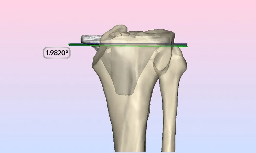tibial_acc_resection_plane.jpg